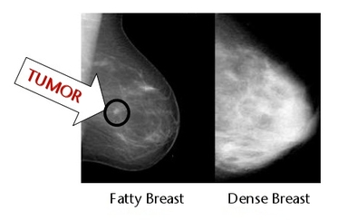 Dense Breast Mammogram