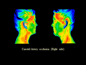 Carotid Artery Occulsion