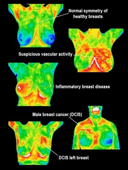 Breast Abnormalities